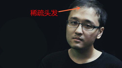 我不要秃头 